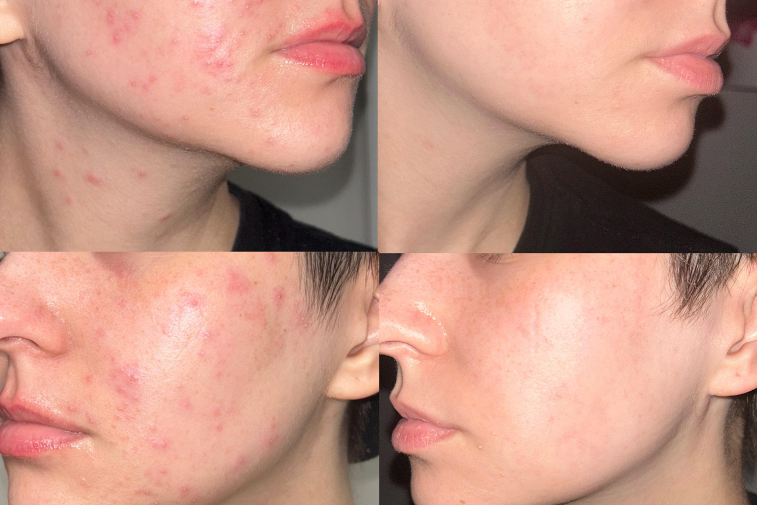 Fast Way to Treat Acne: The Simple Routine That Finally Cleared My Skin