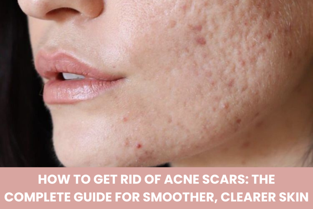 How to get rid of acne scars with skincare products and treatments