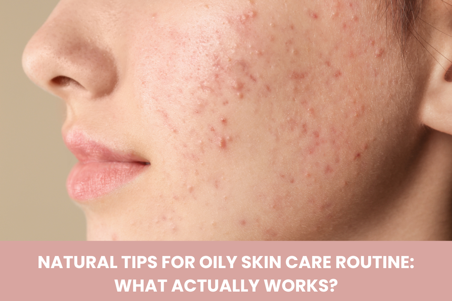Why Your Acne Keeps Coming Back in the Same Spot (And How to Stop It)