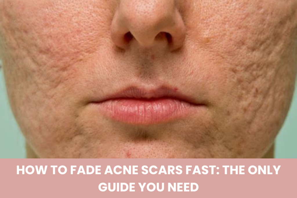 How to fade acne scars fast with skincare products and treatments