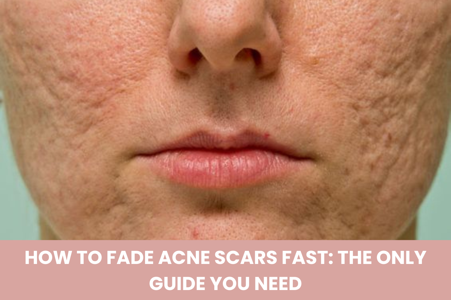 How to Fade Acne Scars Fast: The Only Guide You Need (2026)