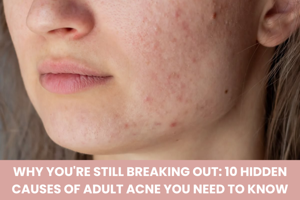 Hidden causes of adult acne and recurring breakouts