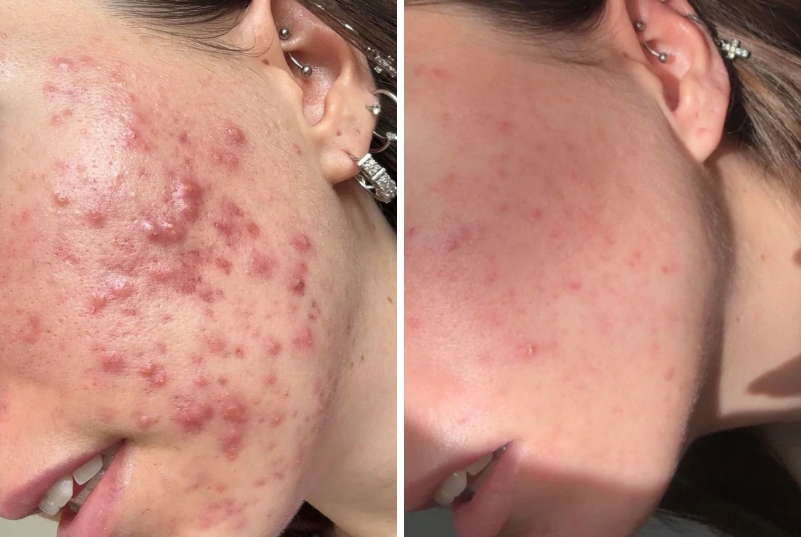 Gentle 10-Step Skincare Routine for Acne-Prone Skin in 2026