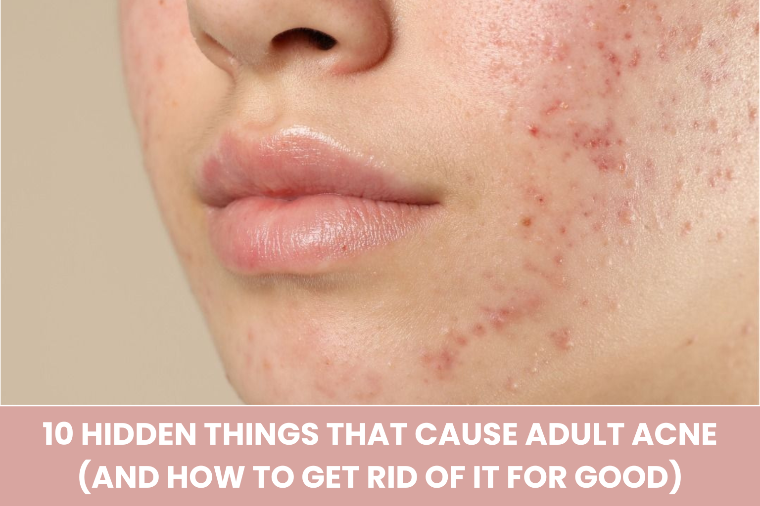 10 Hidden Things That Cause Adult Acne (And How to Get Rid of It for Good)